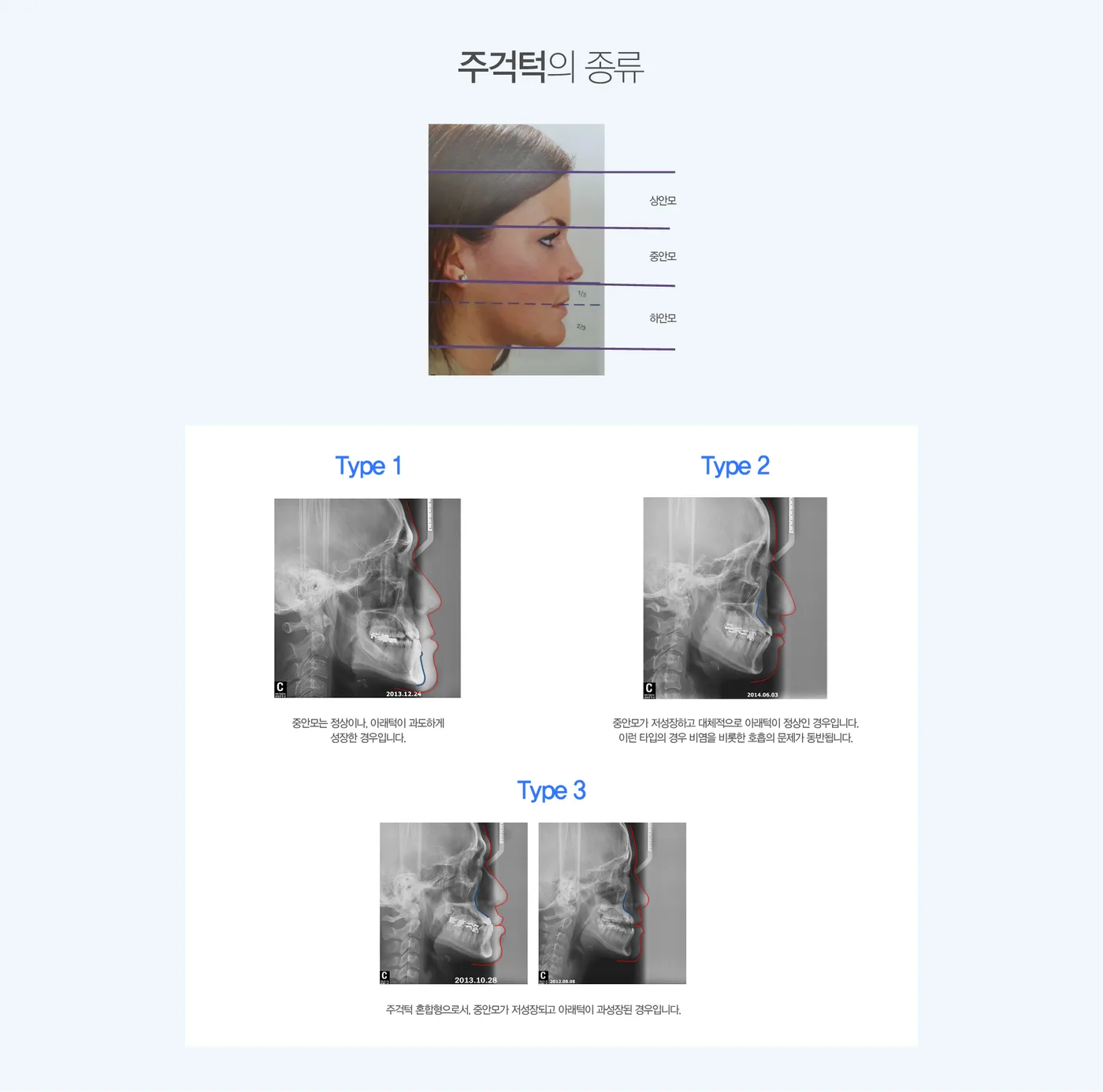 주걱턱의 세 가지 유형 도해 — 아래턱 과성장형, 중안모 저성장형, 혼합형